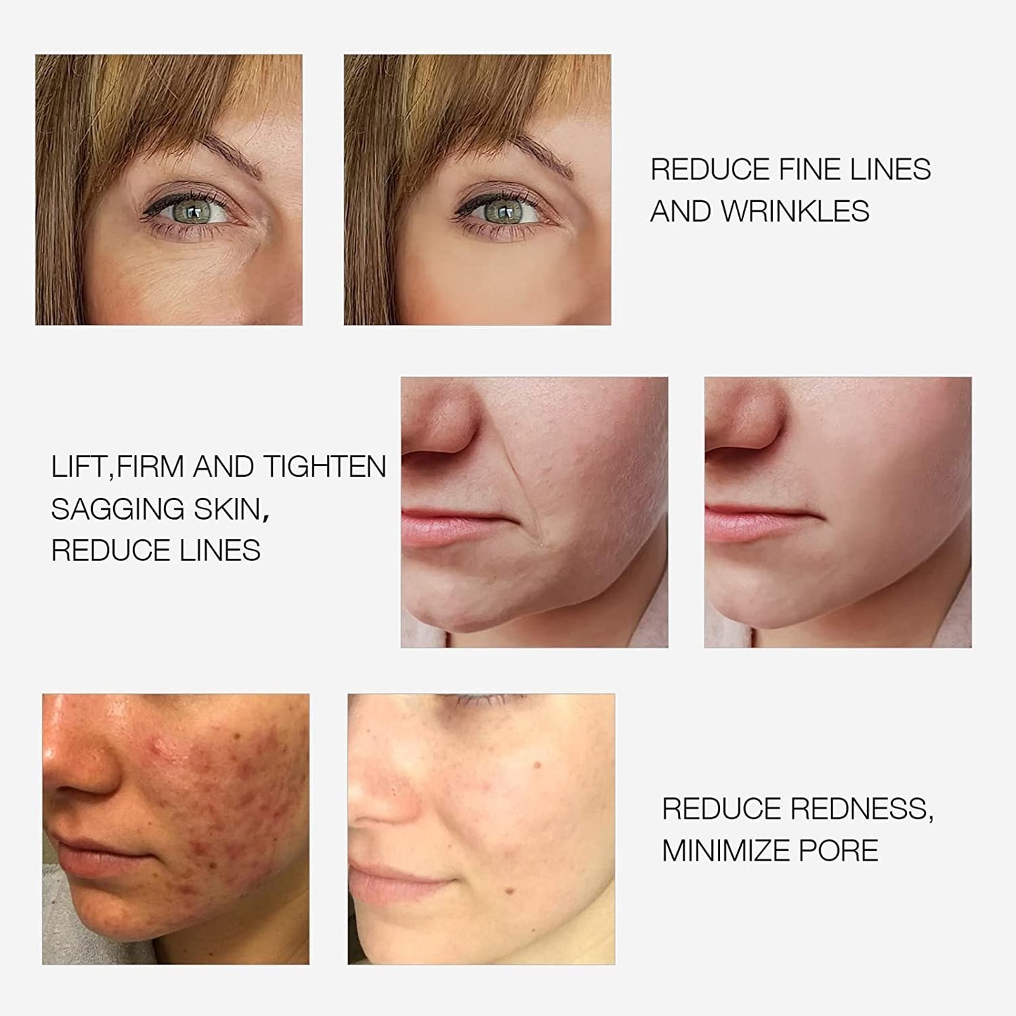 Bipolar RF Facial Beauty Device