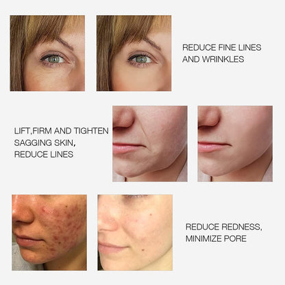 Bipolar RF Facial Beauty Device
