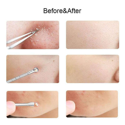 Blackhead Remover Kit